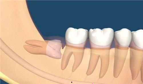 智齿拔了可以吃小瓜,小瓜助力快速恢复